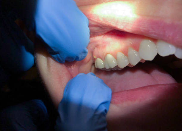 Best Tooth Infection Emergency Dentist  in Bayard, NE